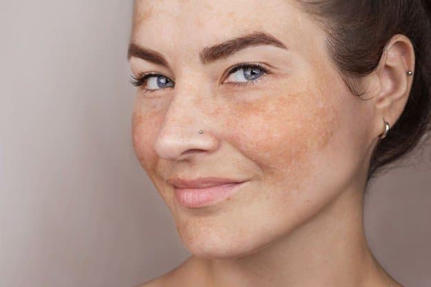 Lentigos solares: qué son y cómo prevenirlos