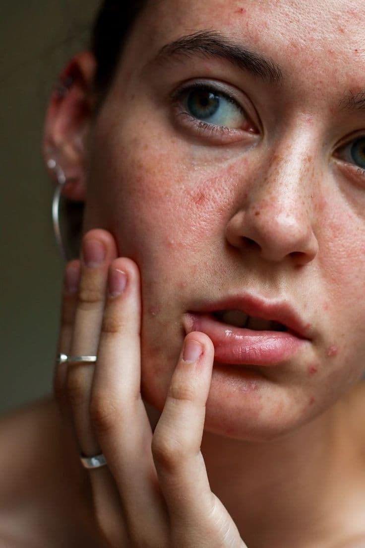 Por qué tu piel está empeorando aunque estás usando skincare?